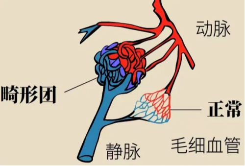 交大一附院榆林医院成功救治动静脉畸形脑出血患者