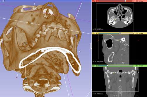 精准治疗“天下第一痛”：DSA导航下三叉神经痛微创术立竿见影