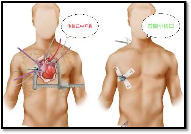 6厘米切口更换"心脏阀门"